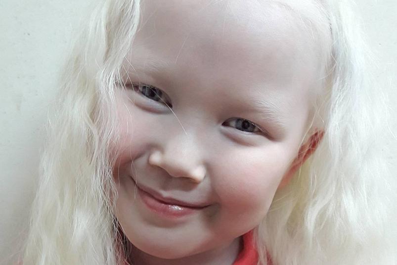Сегодня по НТВ покажут девочку-альбиноса Нарияну из Якутии