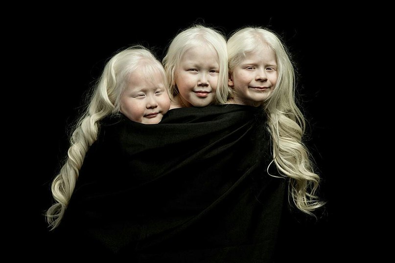Уникальные дети-альбиносы из Якутии ФОТО