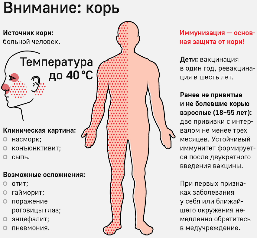 В Якутии корью заболел 51 человек 